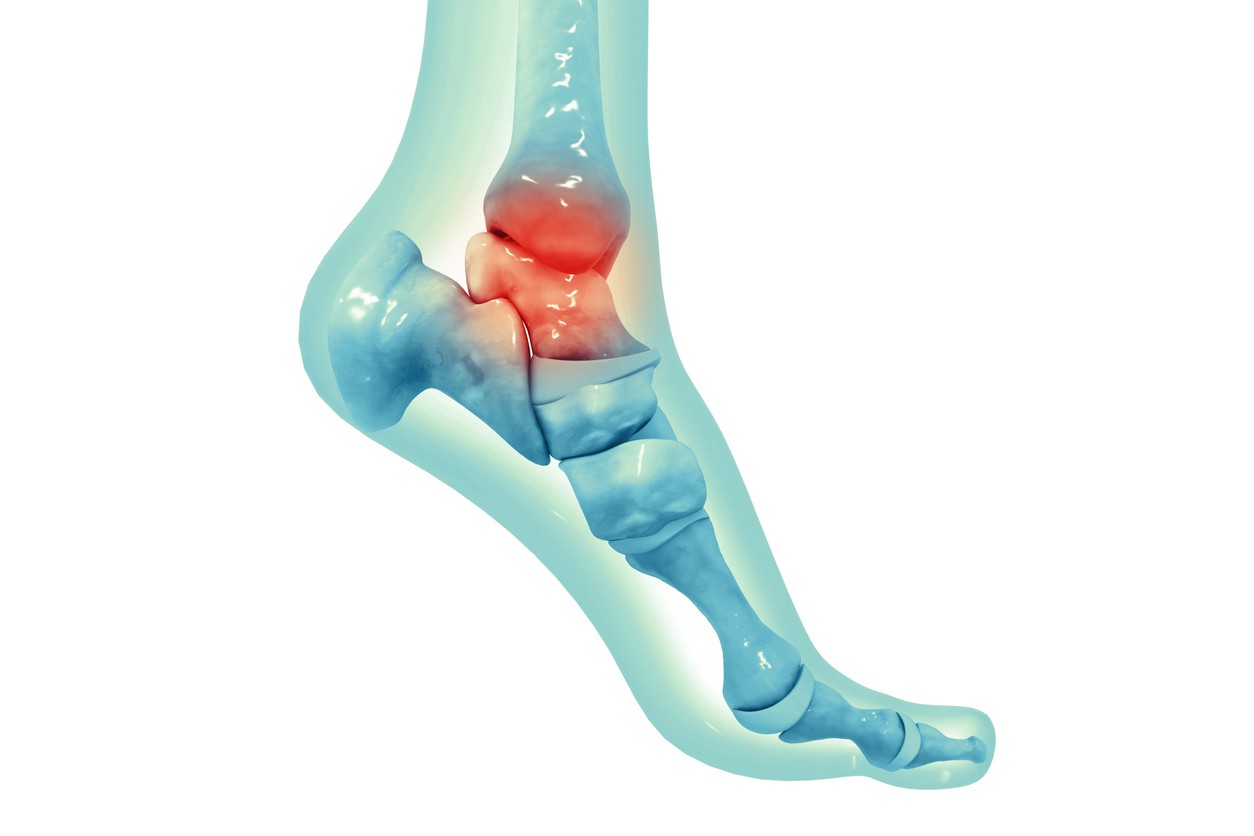 Lesão Osteocondral do tálus ou Lesão da Cartilagem