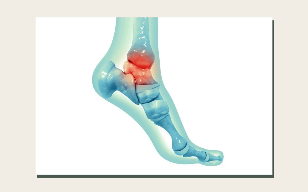 Lesão Osteocondral do tálus ou Lesão da Cartilagem