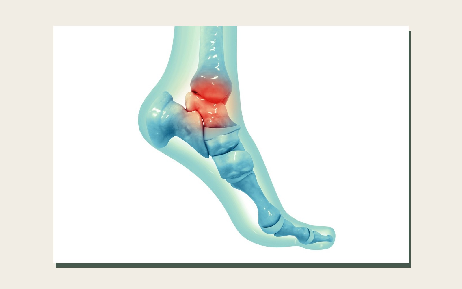 Lesão Osteocondral do tálus ou Lesão da Cartilagem